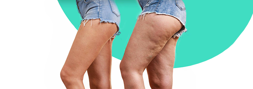Dicas para reduzir a Celulite